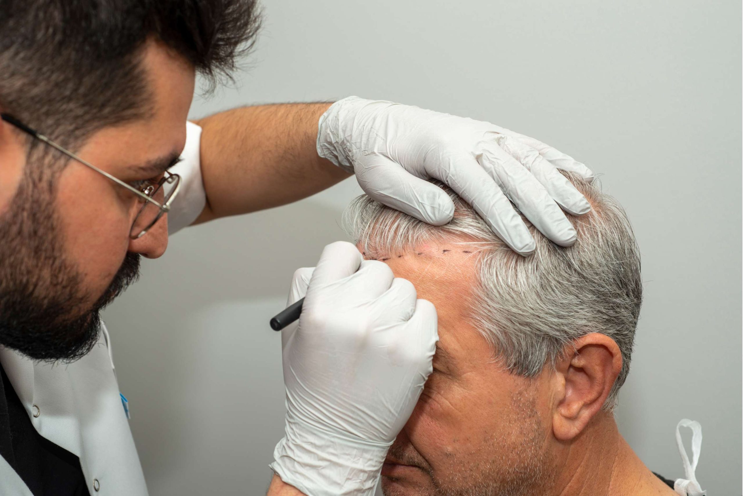Marking hair line Point of receding hair line for hair transplant surgery.